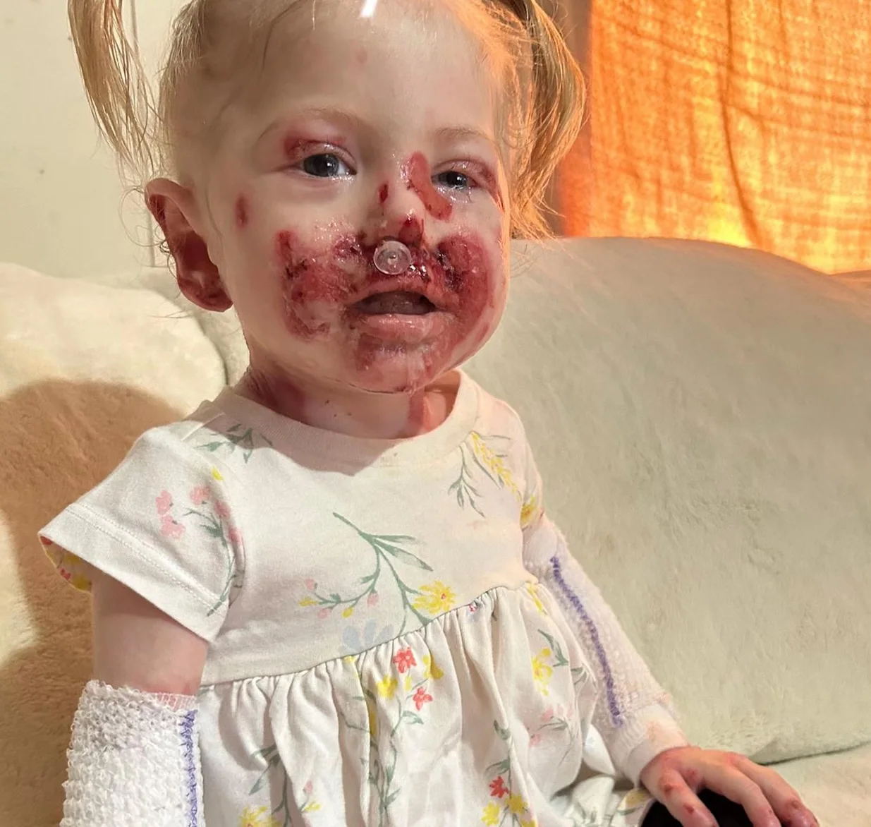 Alice, 2 anos, com lesões de epidermólise bolhosa