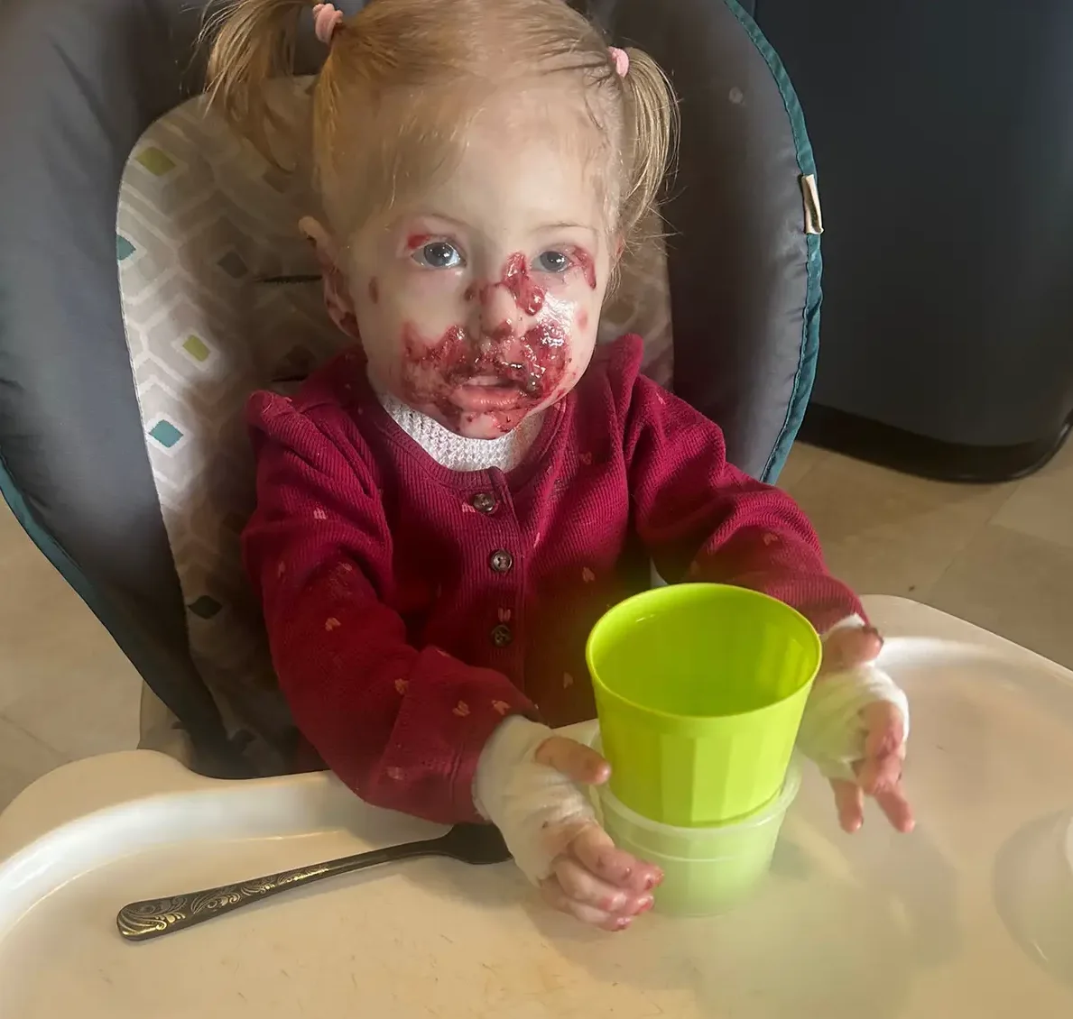 Alice recebendo os cuidados diários com as feridas